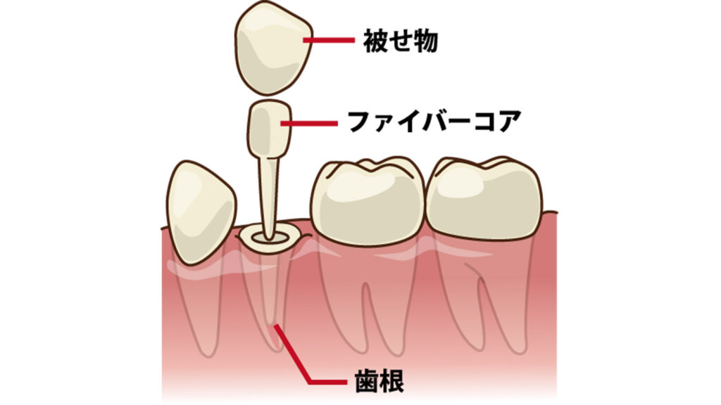 ファイバーコアと被せ物の関係