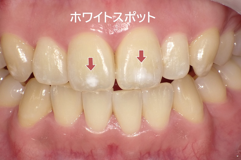 歯の白い斑点・ホワイトスポットの原因と治療法｜削らずに治せる？