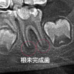 根未完成歯の虫歯C3の治療法