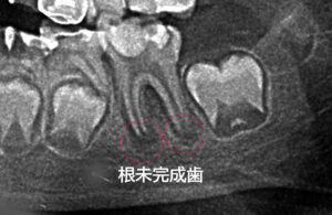 根未完成歯の虫歯C3の治療法