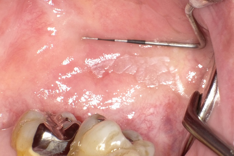 大臼歯の頬粘膜に出来た白板症