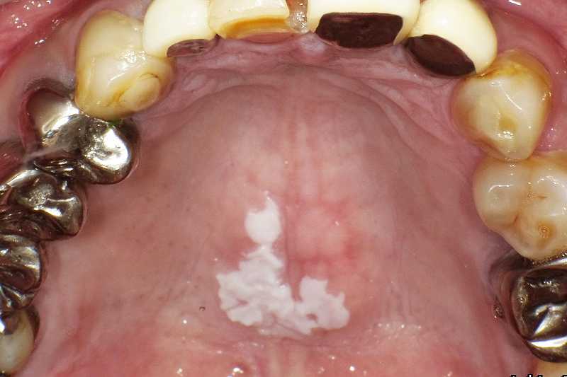 口蓋粘膜にできた白板症