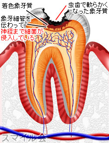 虫歯C3歯髄炎の模式図