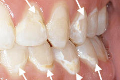 初期虫歯によるホワイトスポット