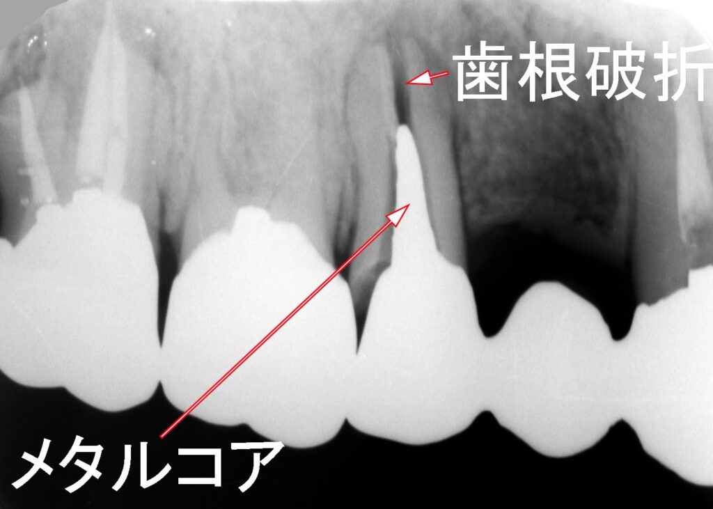 上顎第二小臼歯の歯根破折