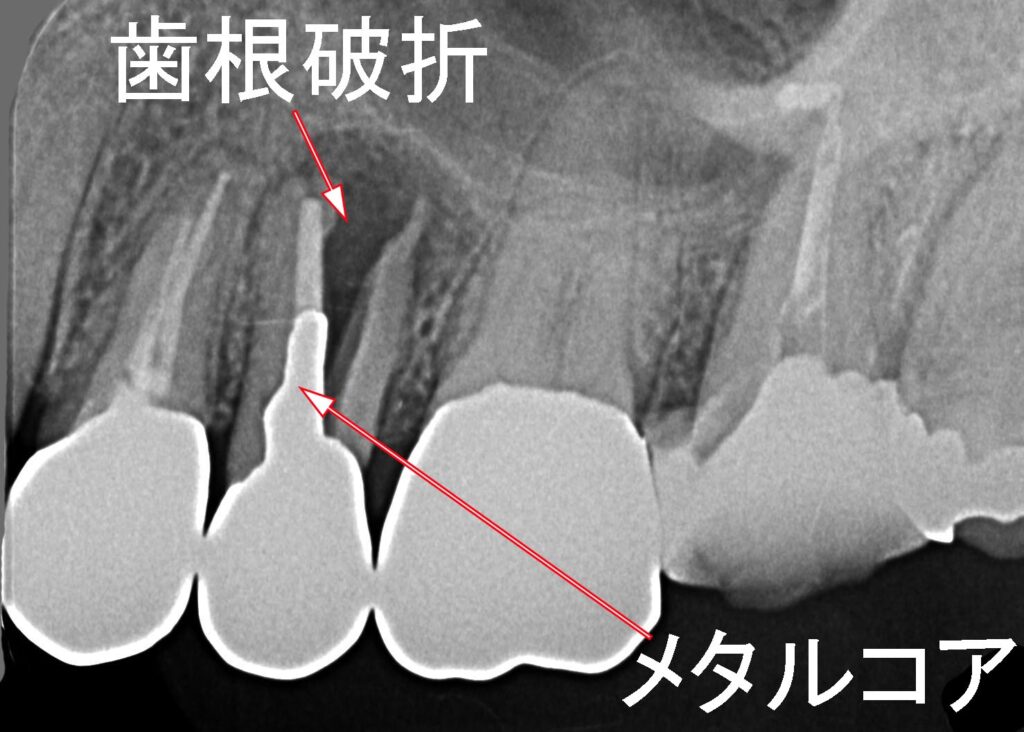 上顎第二小臼歯の歯根破折　症例２