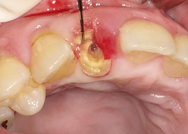 歯根破折した上顎側切歯