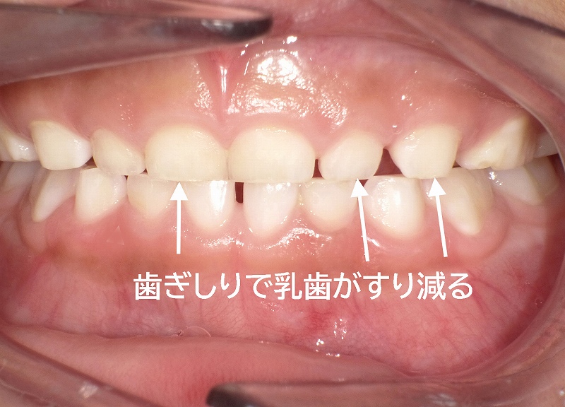 子供の歯ぎしり対策に効果的!おすすめのナイトガードまとめ 5 hjkfnm