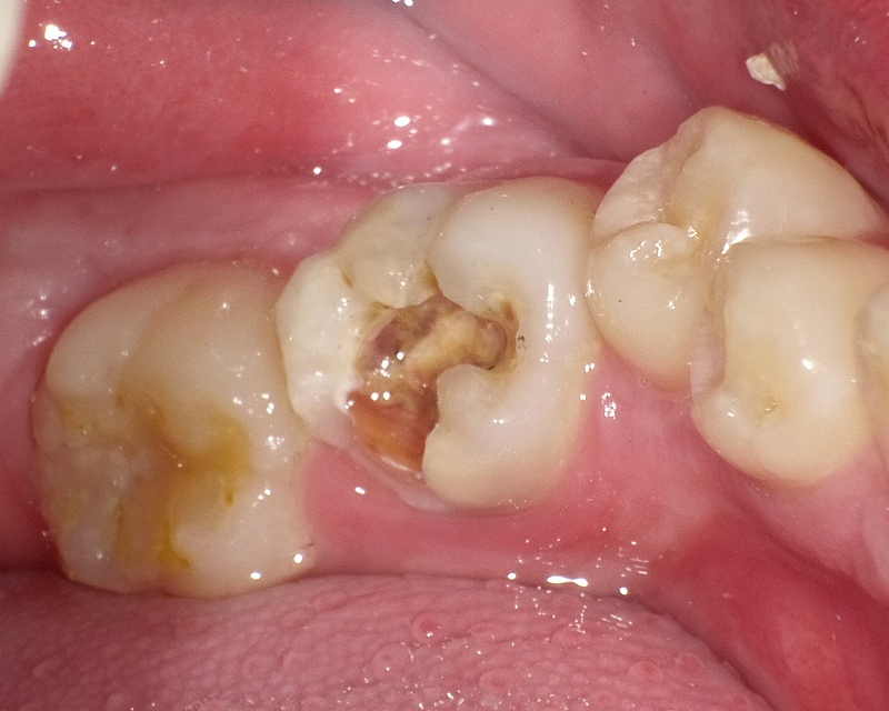 六歳臼歯（第1大臼歯）にひどい虫歯
