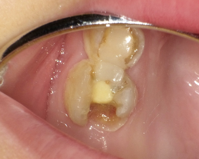 第1乳臼歯と第2乳臼歯の充填後に2次カリエス