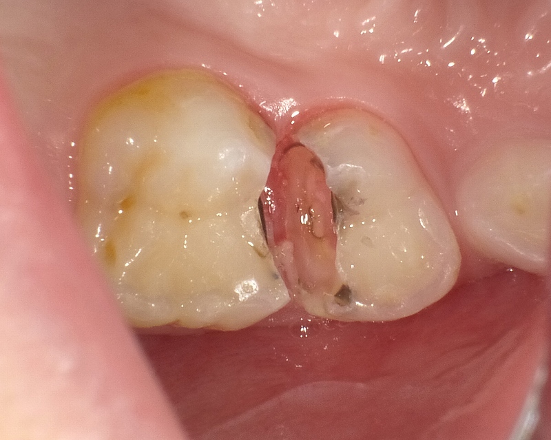第1乳臼歯と第2乳臼歯の虫歯を除去