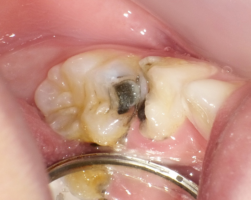第1乳臼歯と第2乳臼歯にひどい虫歯