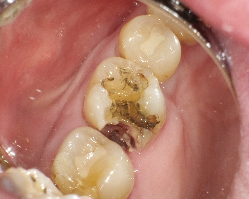 乳臼歯のひどい虫歯