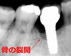 インプラント周囲炎による歯槽骨が吸収