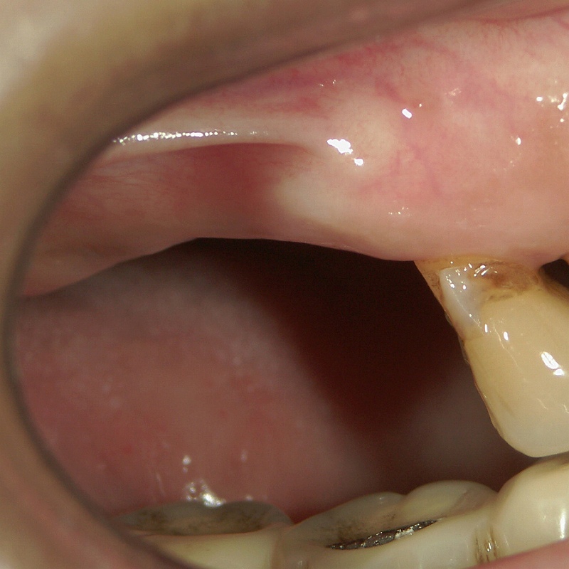 大臼歯相当分の歯槽骨