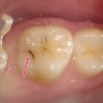乳歯の虫歯は白濁・ 黒変・穴などを見逃すな！