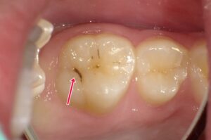 乳歯の虫歯は白濁・ 黒変・穴などを見逃すな！
