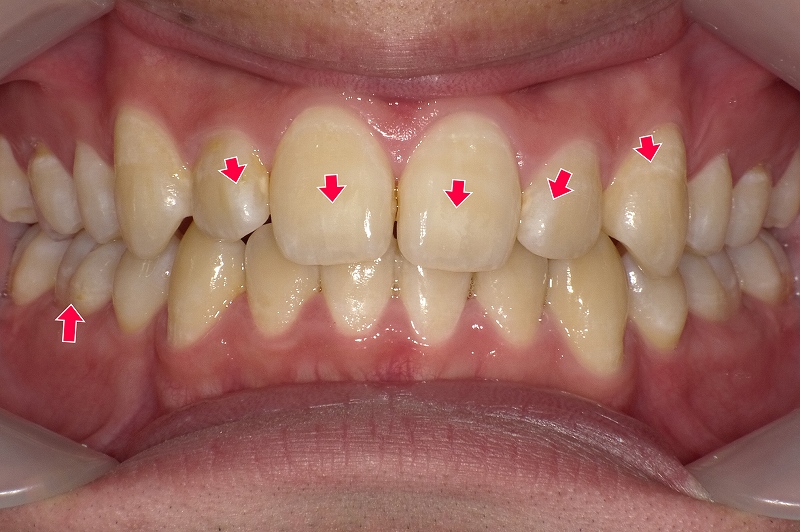 初期虫歯によるホワイトスポット