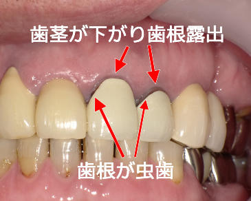 露出した歯根が虫歯