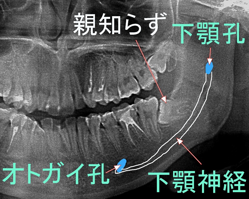 親知らずと下顎神経の位置関係