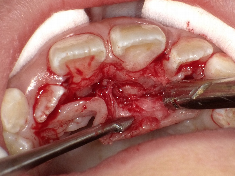 子供の過剰歯の日帰り抜歯手術