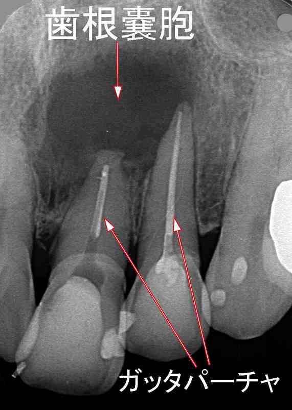 上顎1番が原因の歯根嚢胞のX線写真