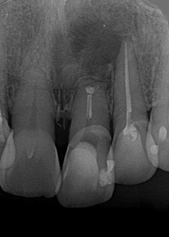 歯根嚢胞摘出術と歯根端切除術のX線写真