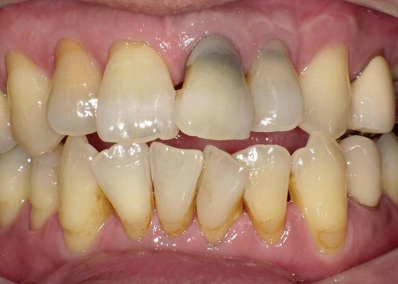 抜髄後の歯の変色