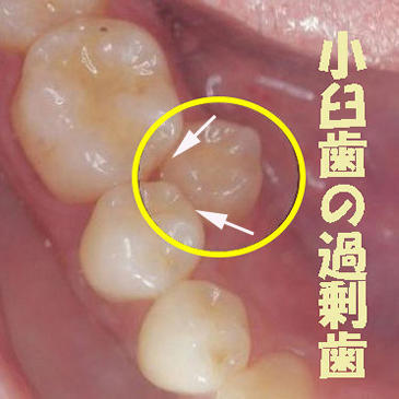 下顎奥歯の過剰歯