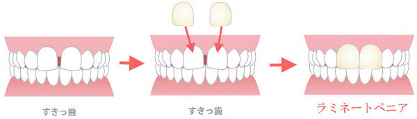 すきっ歯（正中離開）をラミネートベニア修復