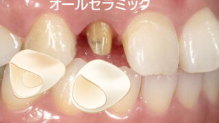 オールセラミックス 歯 kl2yuvc-320x180.jpg