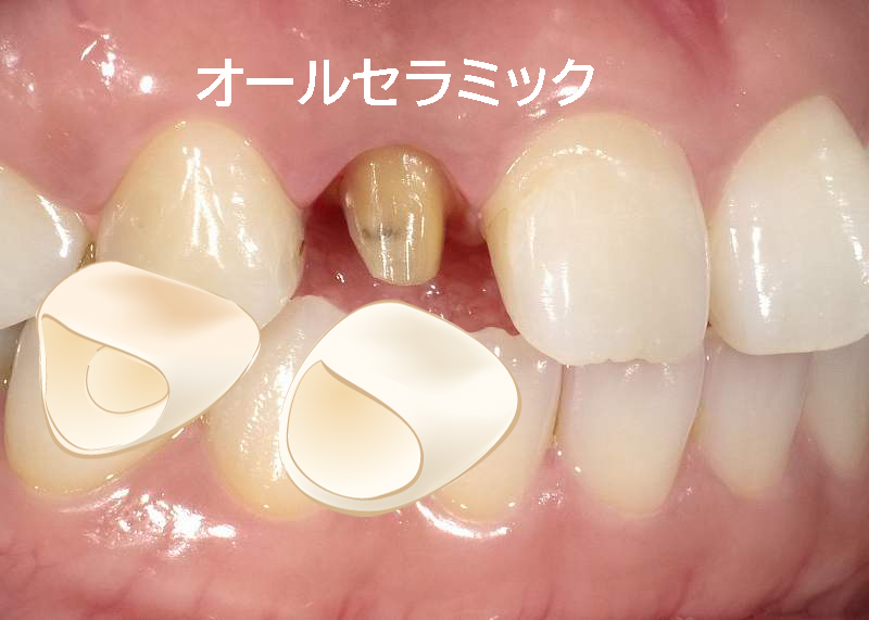 後悔しないためのオールセラミック完全ガイド｜見た目・耐久性・費用を比較