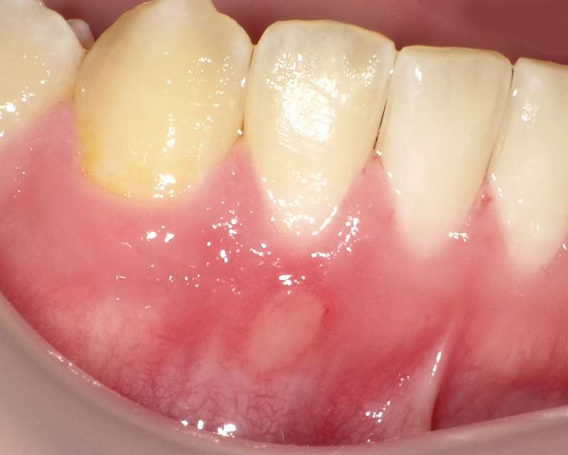 下顎の歯茎にできた口内炎