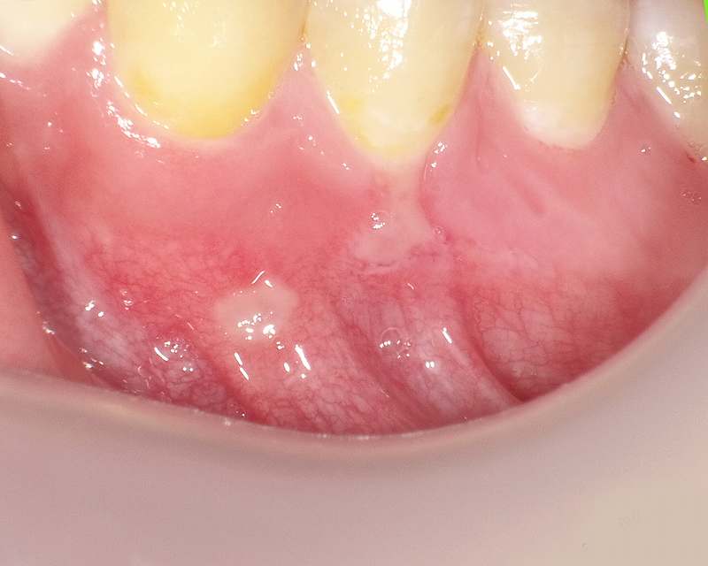 下顎の可動粘膜部分にできた口内炎