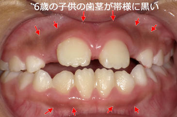 子供の歯茎が帯状に黒い