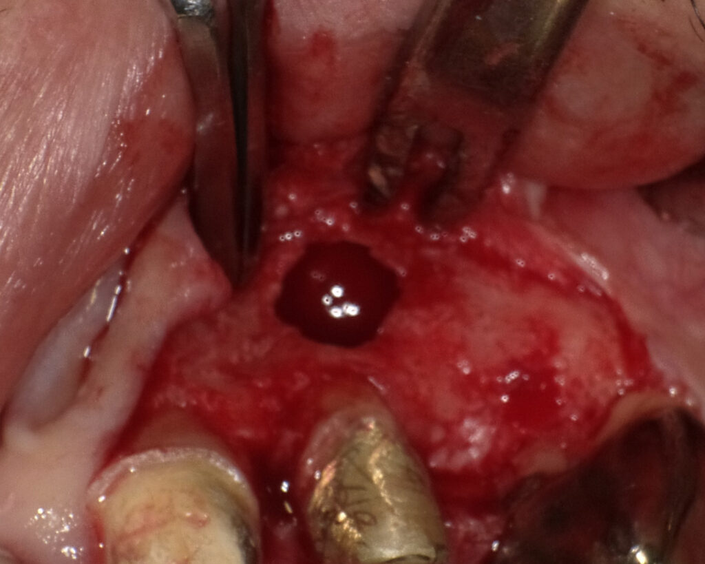 歯根嚢胞の摘出