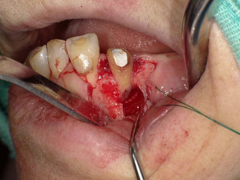 歯茎の切開剥離、歯根嚢胞摘出
