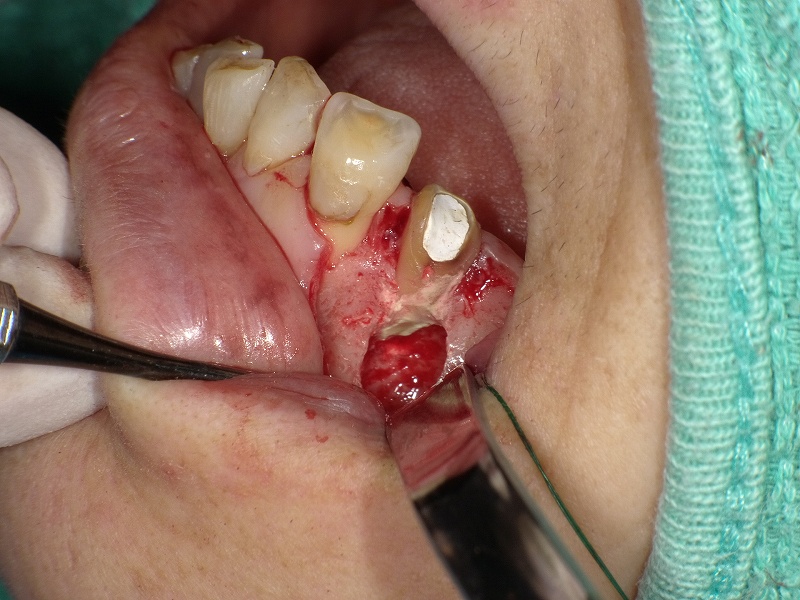 歯根端切除術、逆根充