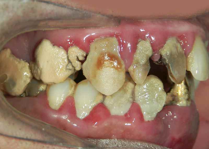 虫歯を10年以上放置した症例 側面