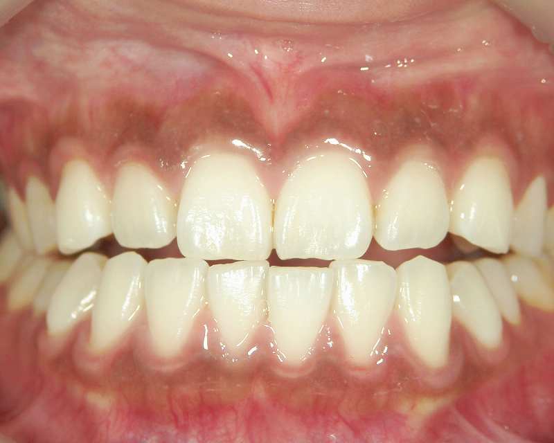 メラニン色素が沈着した黒い歯茎