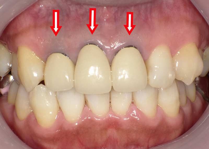 ３本の差し歯の根元の歯茎が黒く変色