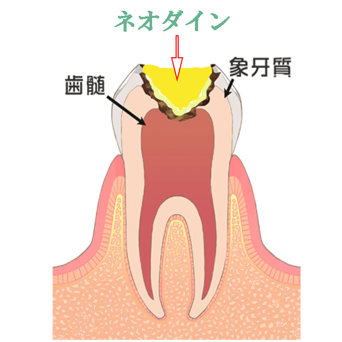 CC+ネオダインの貼薬