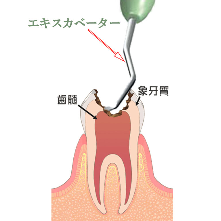 スプーンエキスカベーターで虫歯除去
