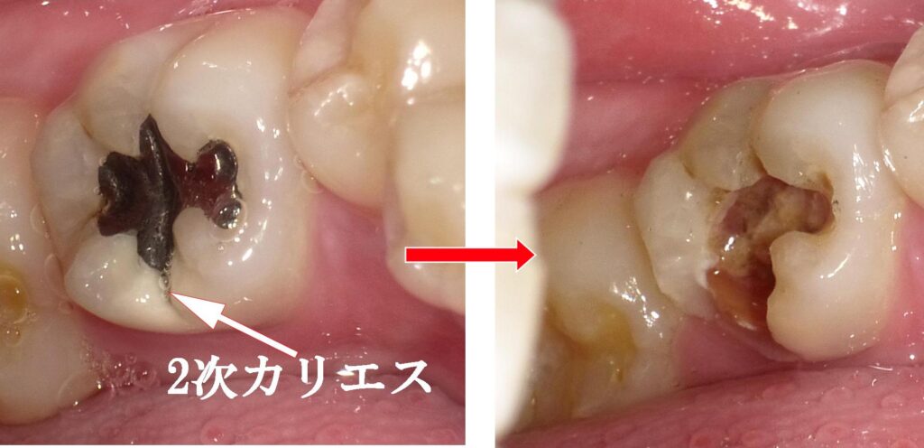 2次　膨らみかけ honto