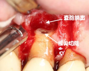 歯根嚢胞摘出手術と歯根端切除術