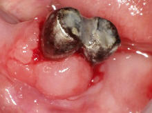 歯周病の急性発作