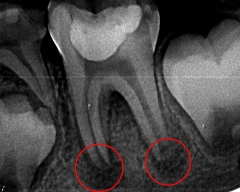 根未完成の第一大臼歯（6歳臼歯）
