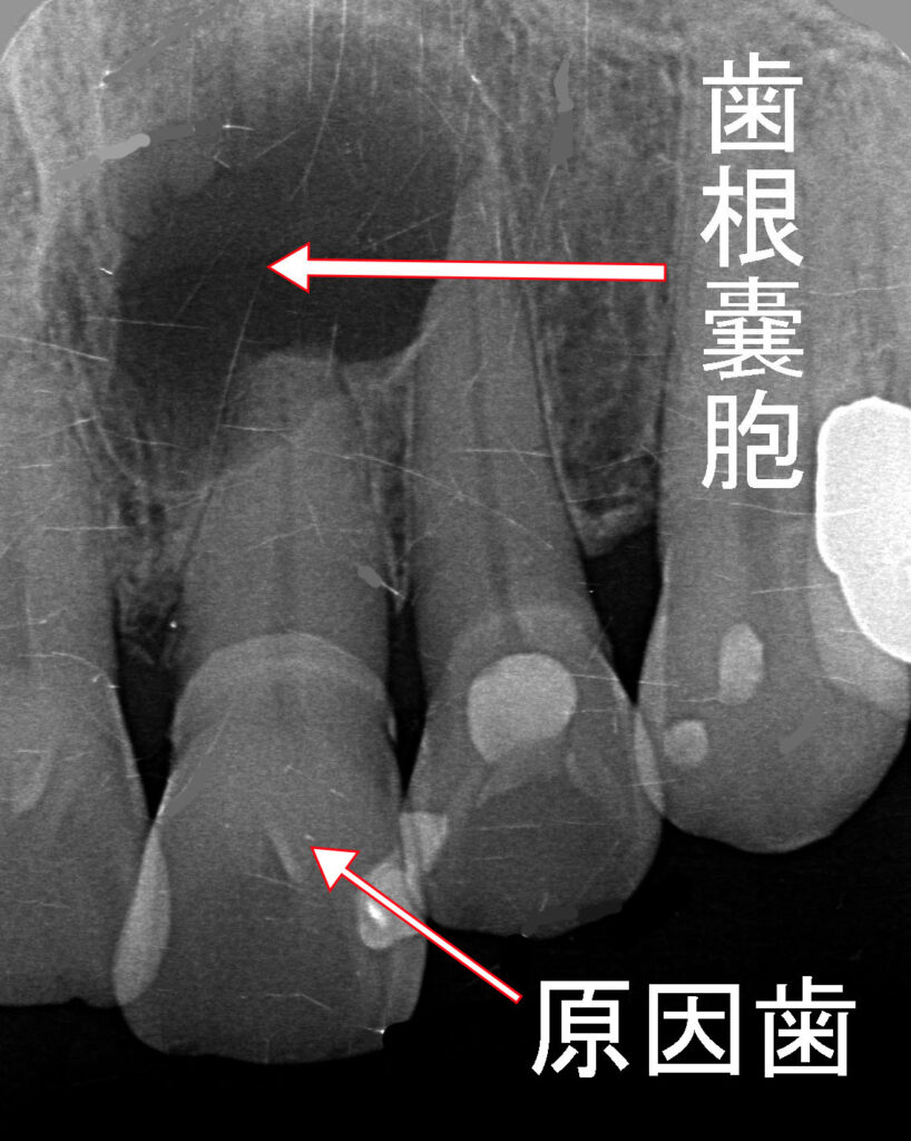 上顎1番を原因歯とする大きな歯根嚢胞