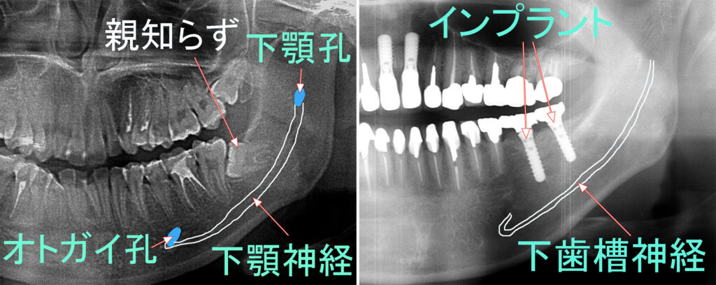 下顎神経麻痺の治療法と回復のための最新アプローチ｜東京都江戸川区篠崎