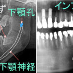 下顎神経（下歯槽神経）の麻痺対策